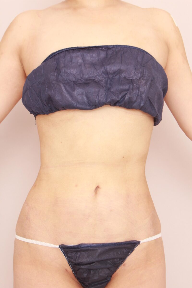 みんなで目指そう峰不二子♡お腹全体胸下腰の脂肪吸引3か月後