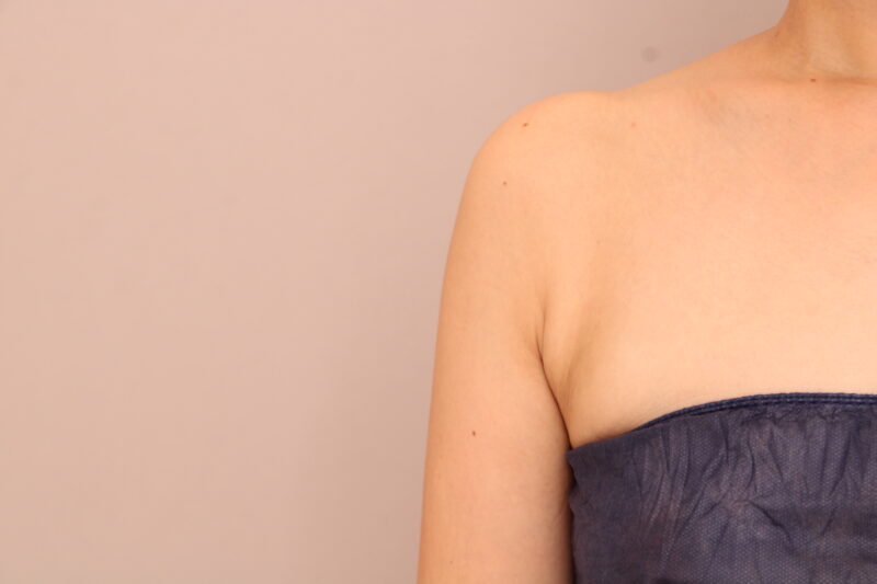 二の腕・肩の脂肪吸引 術後6ヵ月の経過