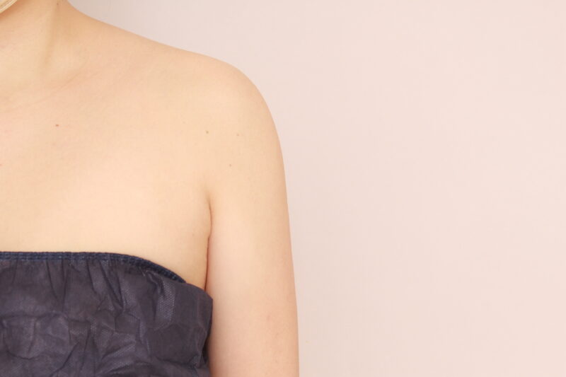 二の腕、肩の脂肪吸引3か月後