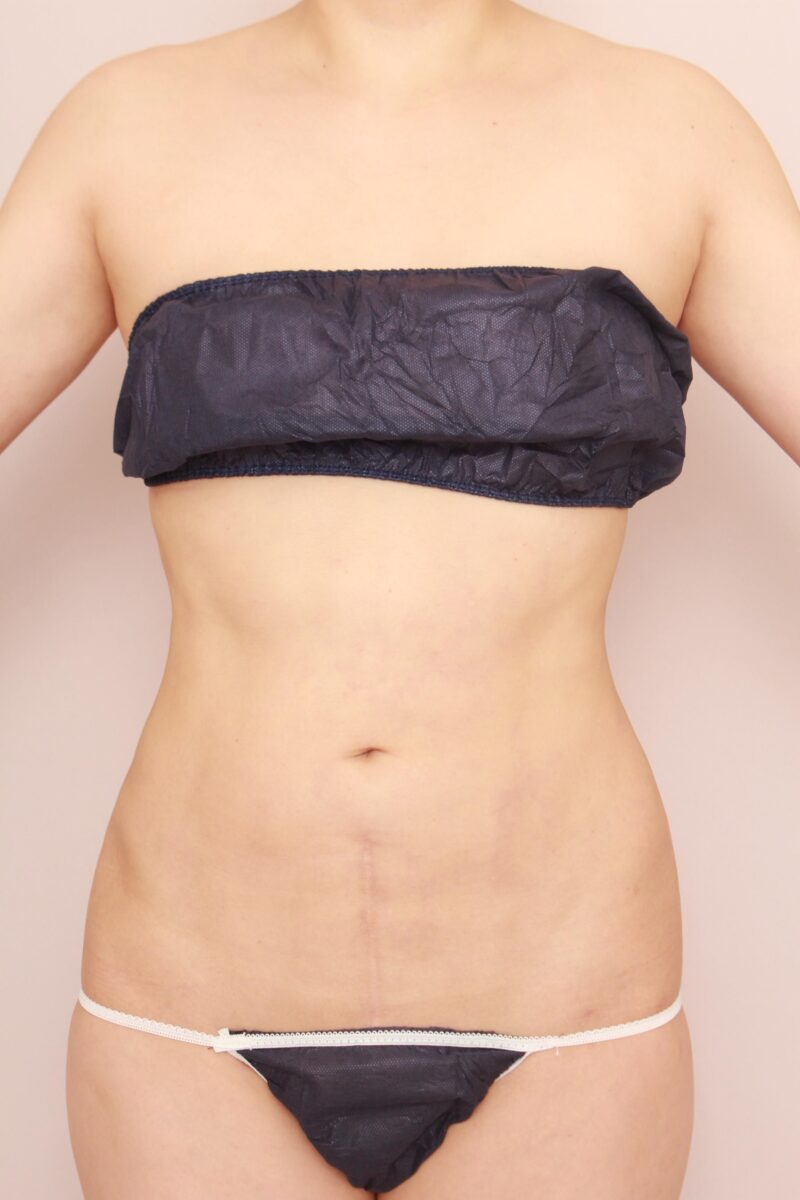 みんなで目指そう峰不二子♡お腹全体胸下腰の脂肪吸引3か月後