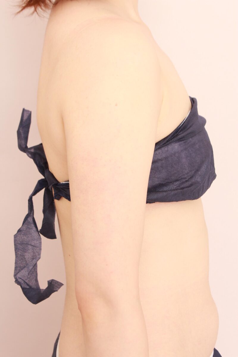 二の腕、肩の脂肪吸引1か月後の変化(太もも激変したリピーター様です♡)