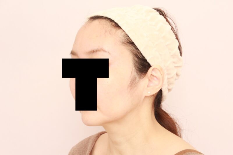 オデコこめかみ、頬コケの脂肪注入でお顔のゴツゴツ感を軽減しましょう♪