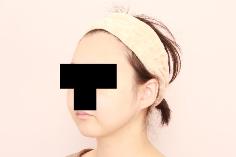 リピーター様のほほ顎脂肪吸引の半年後の変化♡