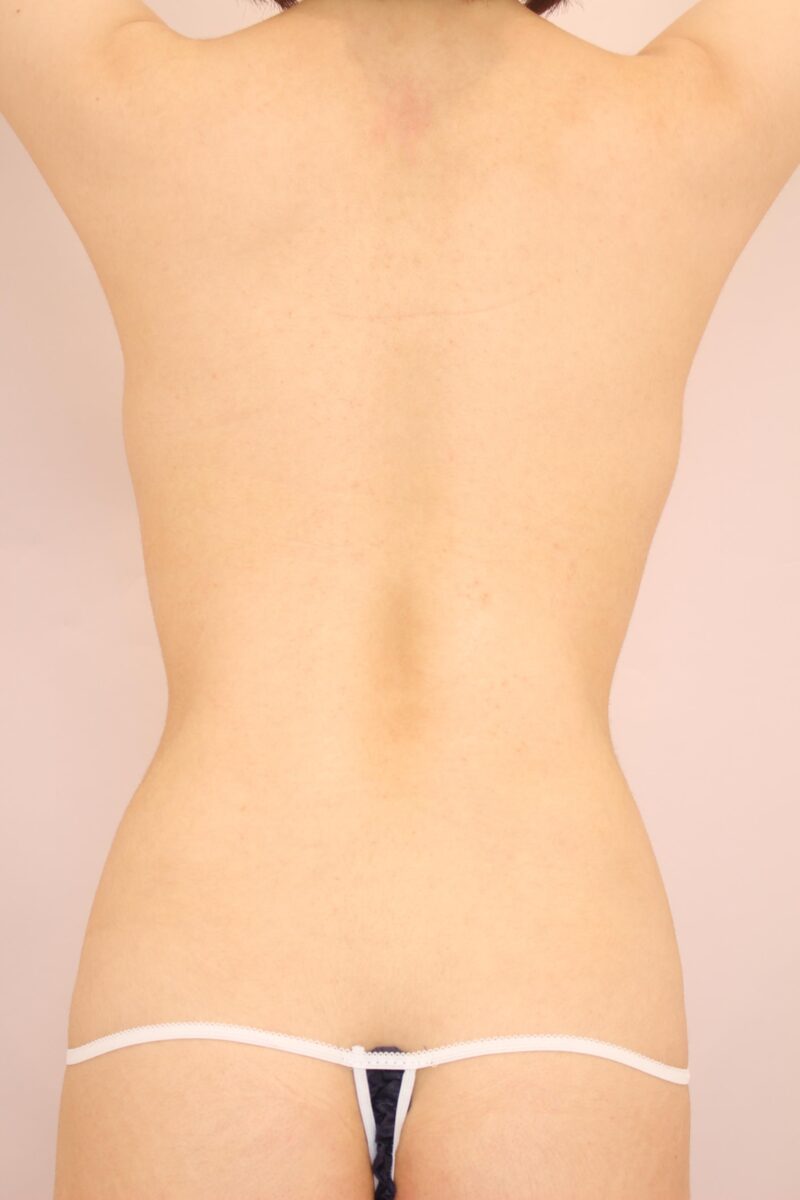 みんなで目指そう峰不二子♡やせ型のモニター様のお腹全体胸下腰の脂肪吸引