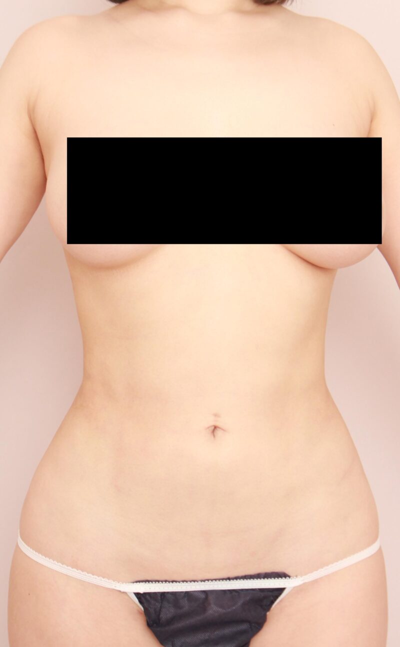 みんなで目指そう峰不二子♡モデルさんのお腹全体胸下腰の脂肪吸引&ヒップ注入3か月後