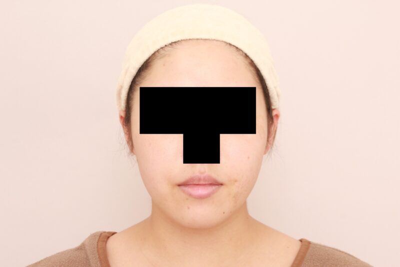 ほほ顎脂肪吸引のモニター様半年後