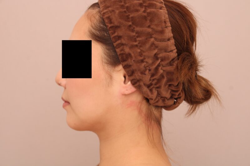 お顔の脂肪吸引 術後3ヵ月の経過