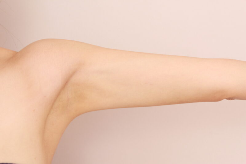 二の腕・肩の脂肪吸引 術後6ヵ月の経過