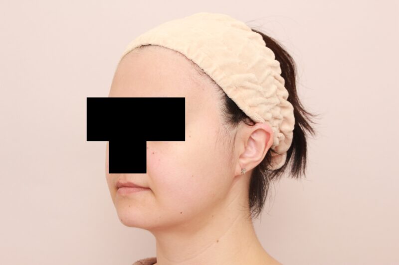 結婚式へ向けてほほ顎脂肪吸引1か月後♡