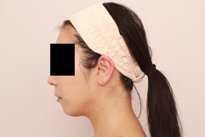 お顔の脂肪吸引 術後6ヵ月の経過