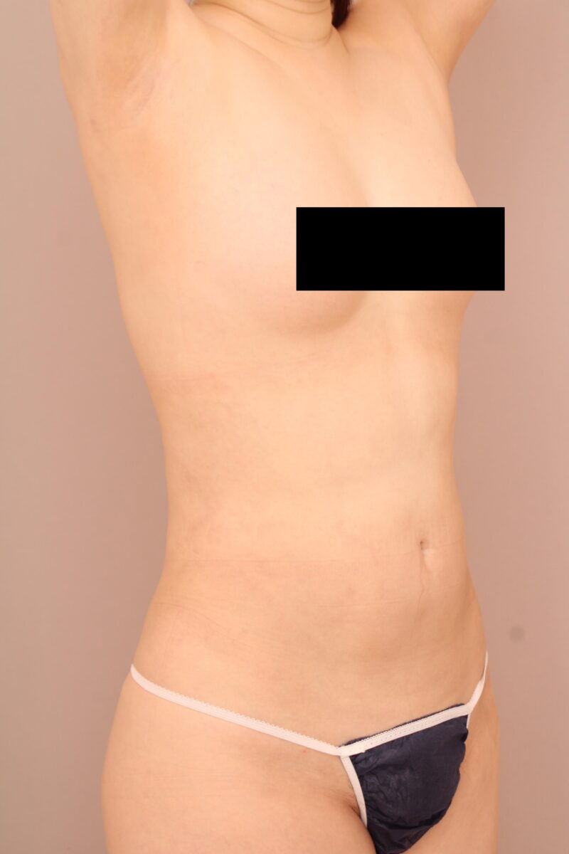 お腹・腰の脂肪吸引 術後3カ月の経過