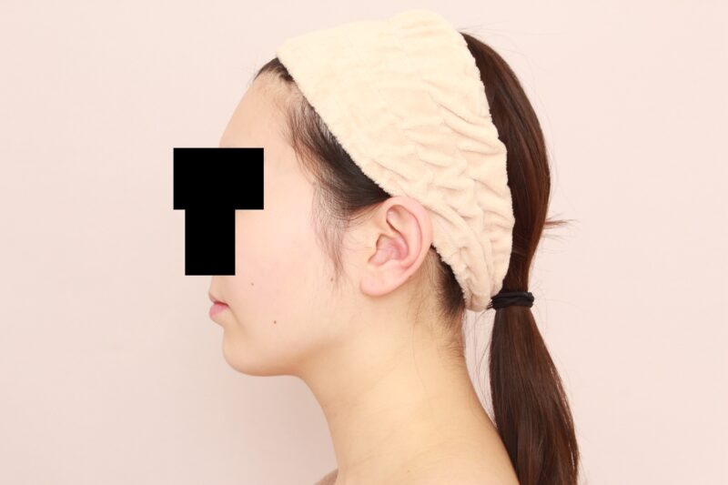 ほほ顎脂肪吸引でより洗練された印象に♪