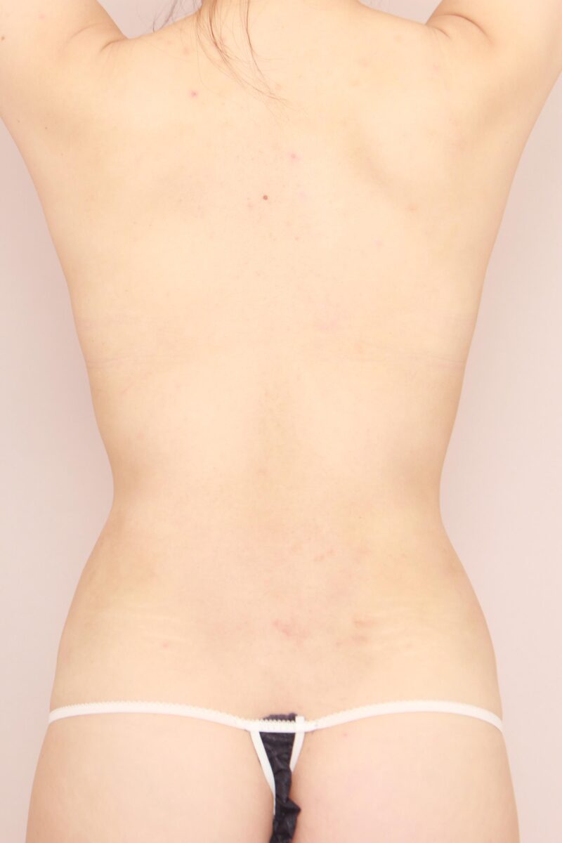 みんなで目指そう峰不二子♡お腹全体胸下腰の脂肪吸引のモニター様3か月後