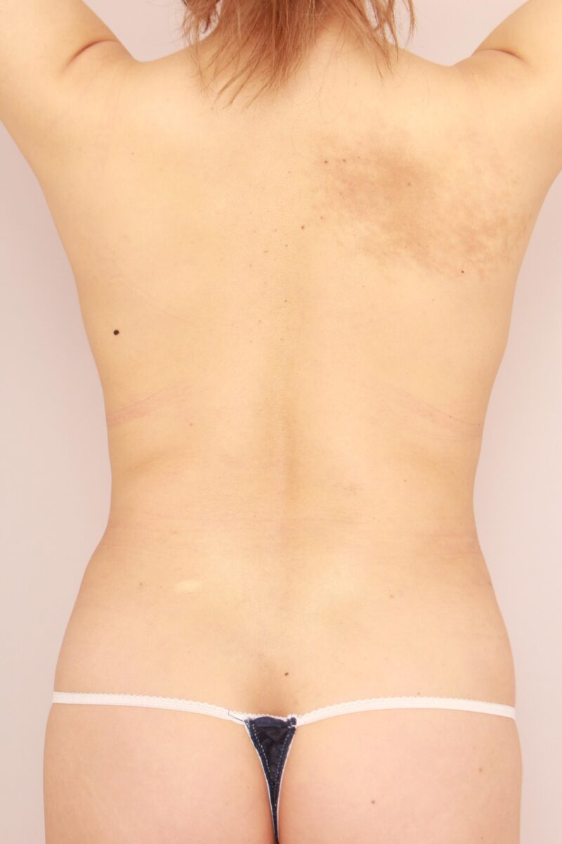 お腹・腰の脂肪吸引 術後3カ月の経過