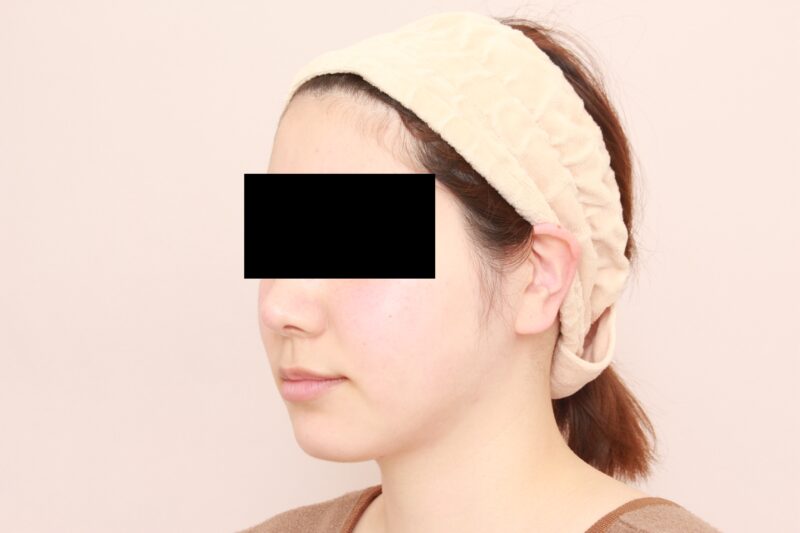 お顔の脂肪吸引 術後3カ月の経過