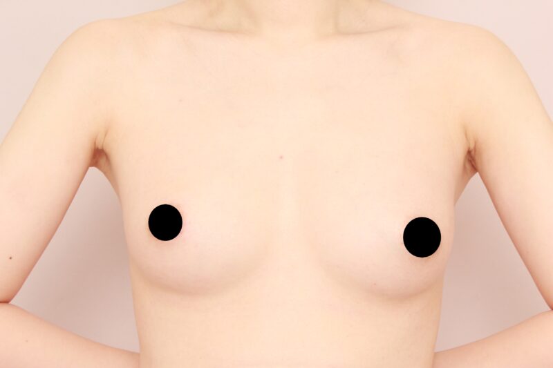 コンデンスリッチ豊胸でふっくら美バスト♡8か月後