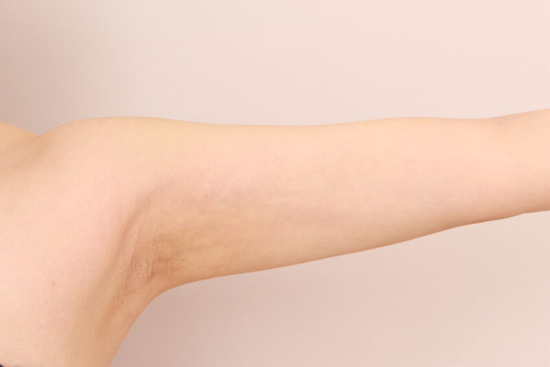 二の腕・肩の脂肪吸引 術後1カ月の経過