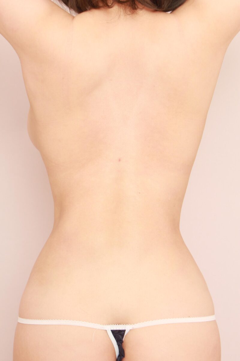 みんなで目指そう峰不二子♡モデルさんのお腹全体胸下腰の脂肪吸引＆ヒップ注入3か月後