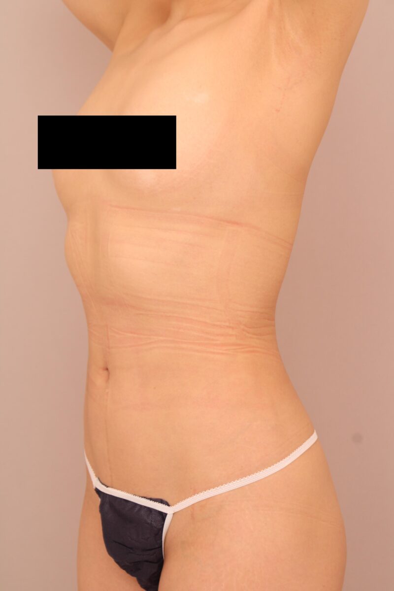 お腹・腰の脂肪吸引 術後6ヵ月の経過