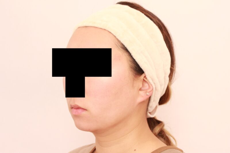 フェイスライン激変!ほほ顎脂肪吸引3か月後♪