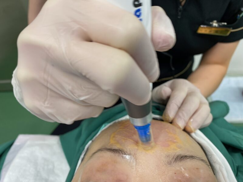 マイクロCRFダーマペン 地味に人気になってるようです・・・