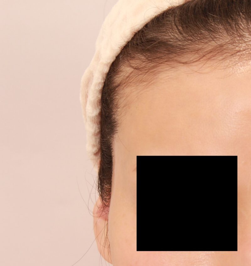 オデコこめかみの脂肪注入でエイジングケア♡