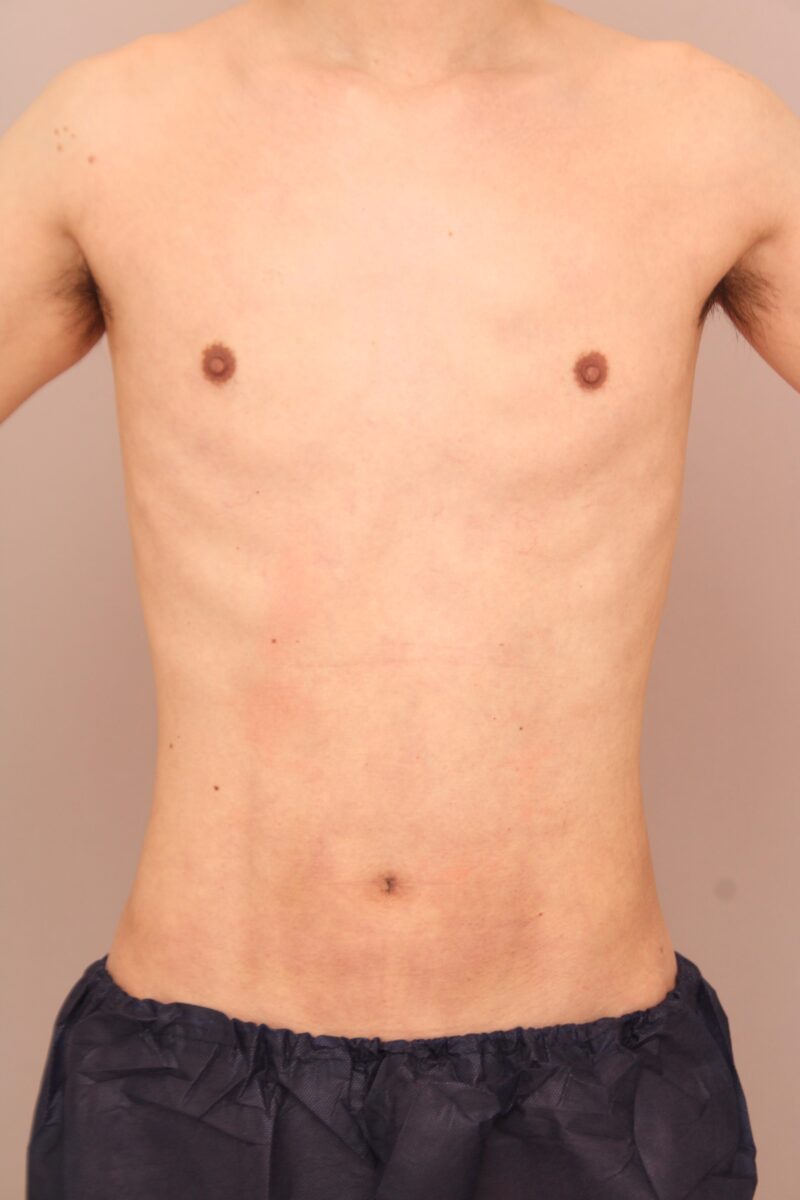 男性の胸・お腹・腰の脂肪吸引 術後1ヵ月の経過