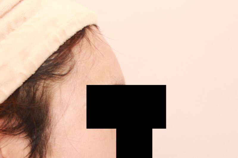 男性のオデコこめかみの脂肪注入1か月後