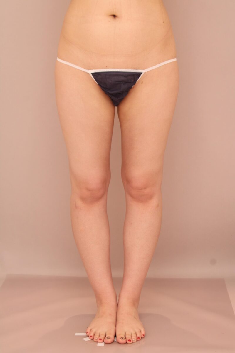 太ももの脂肪吸引 術後6ヵ月の経過