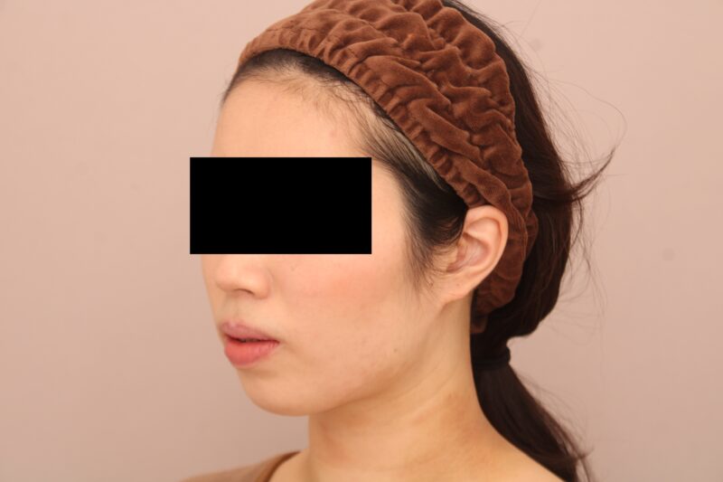 お顔の脂肪吸引 術後1ヵ月の経過