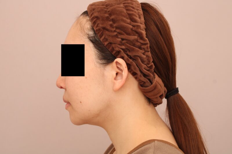 お顔の脂肪吸引 術後3ヵ月の経過