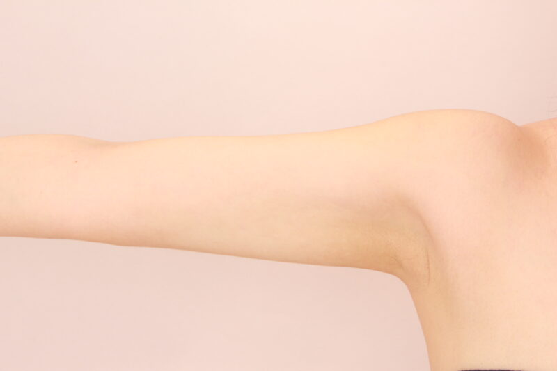二の腕を華奢に♡二の腕、肩の脂肪吸引3か月後♪