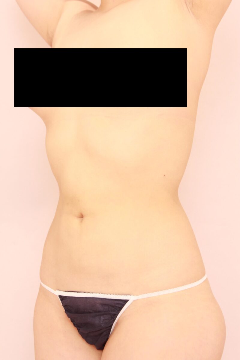 みんなで目指そう峰不二子♡お腹全体胸下腰の脂肪吸引3か月後♡