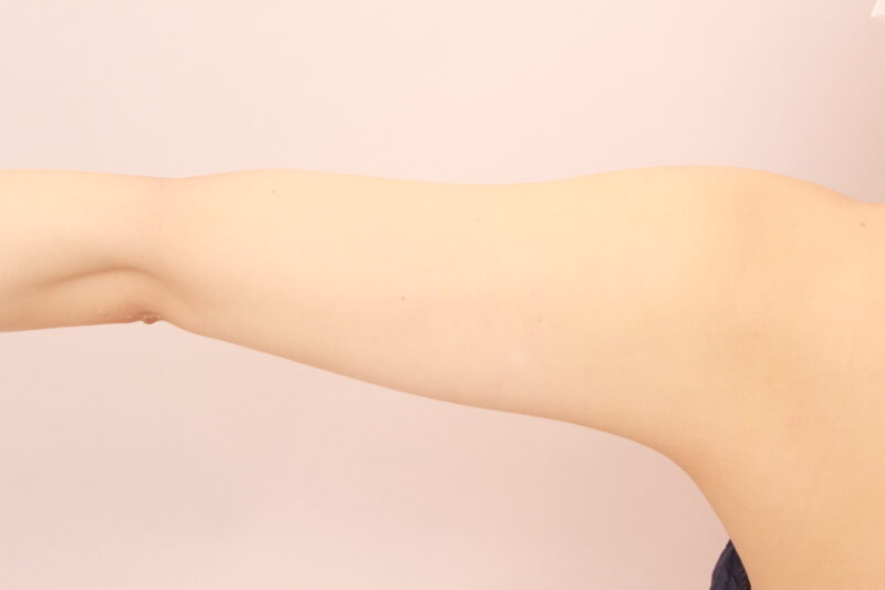 二の腕・肩の脂肪吸引 術後6カ月の経過
