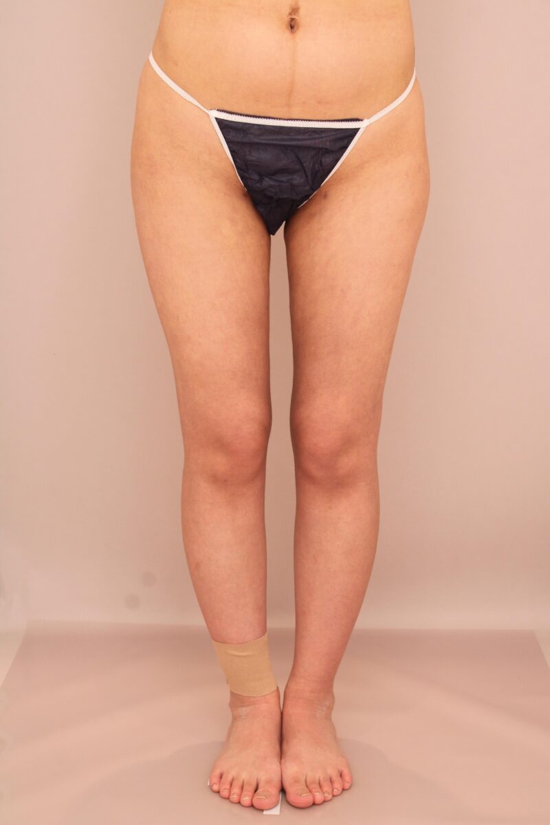 太ももの脂肪吸引 術後1カ月の経過