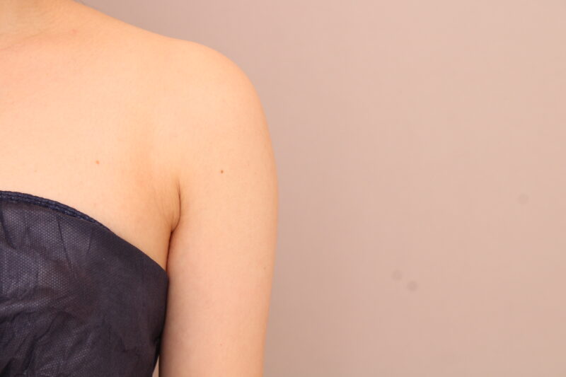 二の腕・肩の脂肪吸引 術後3ヵ月の経過