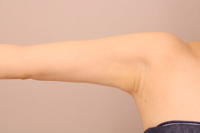 二の腕・肩の脂肪吸引 術後6ヵ月の経過