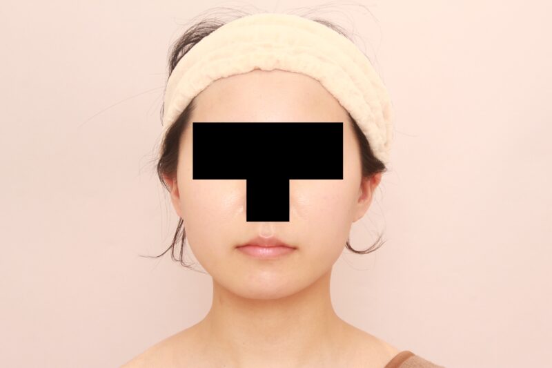 ほほ顎脂肪吸引でまっすます美人さんに♡半年後