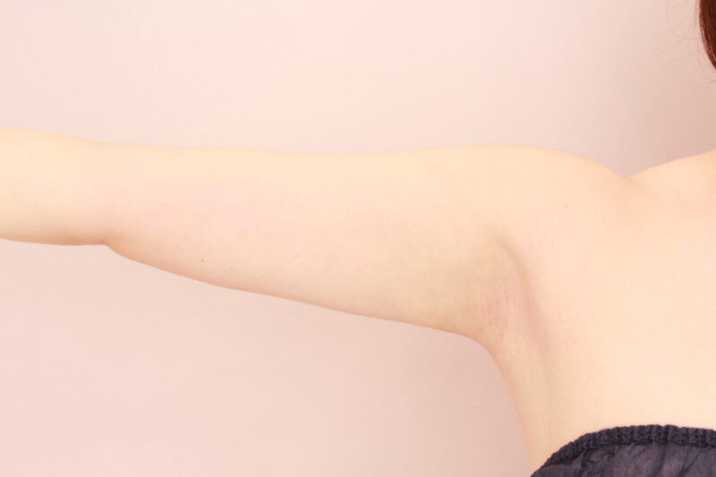 二の腕・肩の脂肪吸引 術後1カ月の経過