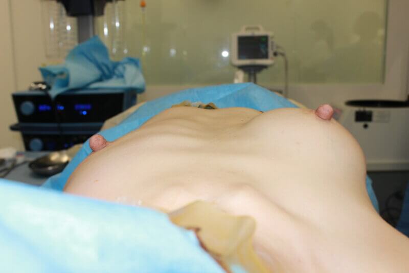 抜去後のバスト