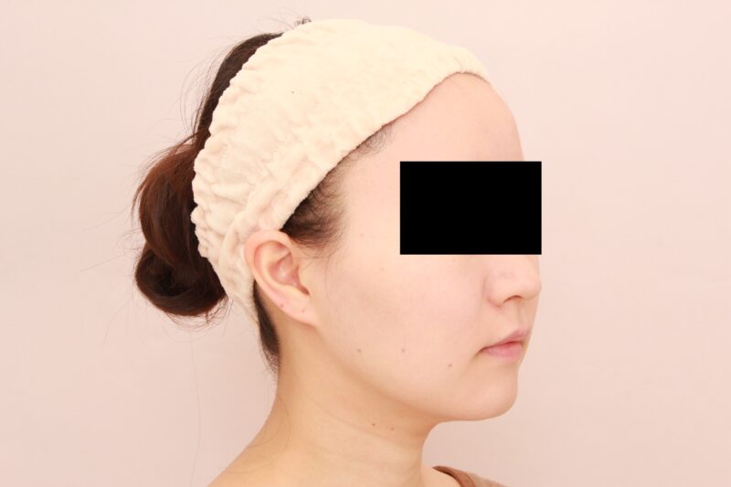 お顔の脂肪吸引 術後3カ月の経過