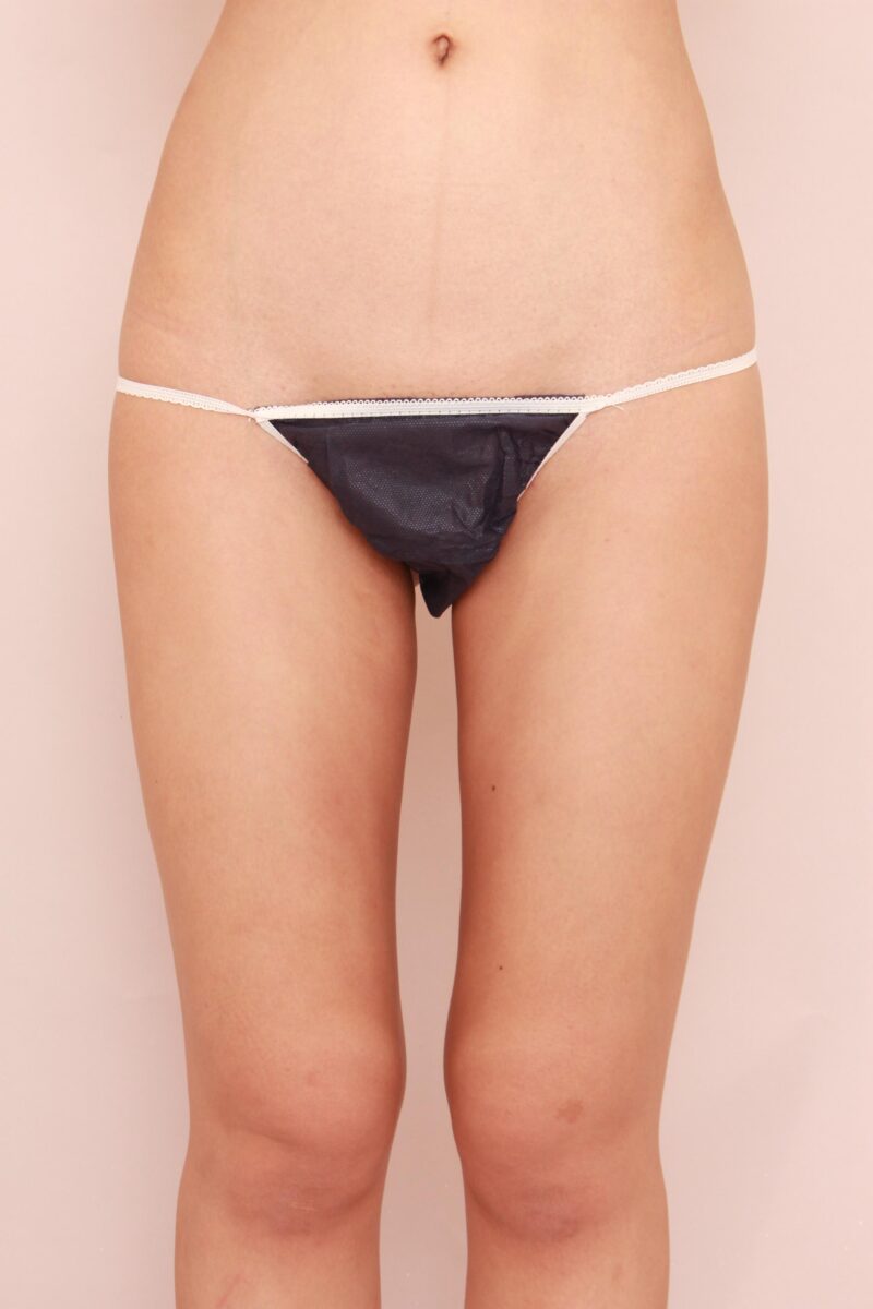 太もも全周、お尻の脂肪吸引3か月後♡