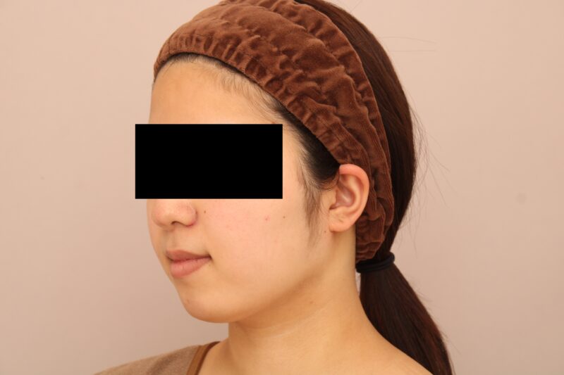 お顔の脂肪吸引 術後6ヵ月の経過