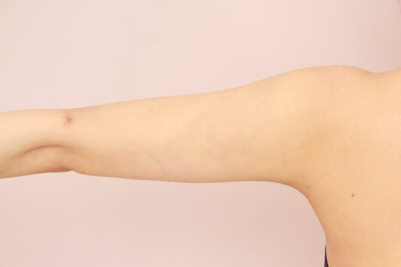 二の腕全周のモニター様1か月後♡