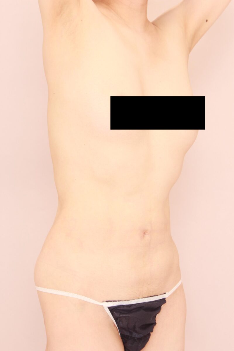 お腹・腰の脂肪吸引 術後3ヵ月の経過