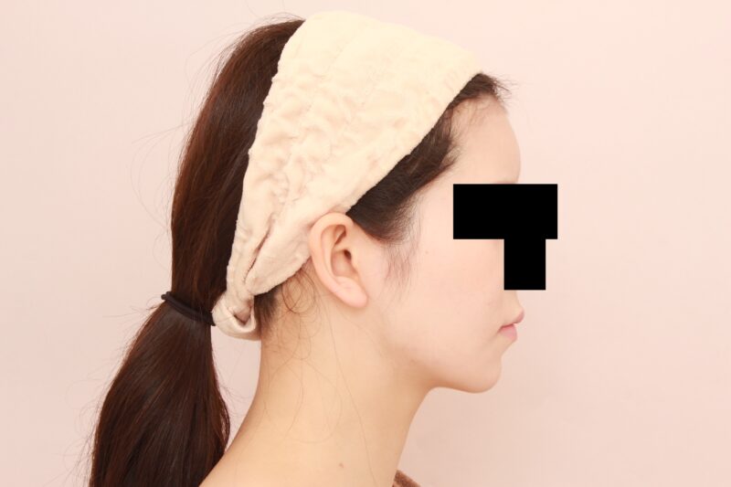 ほほ顎脂肪吸引で女優顔♪カフェで見惚れられるフェイスラインに♡