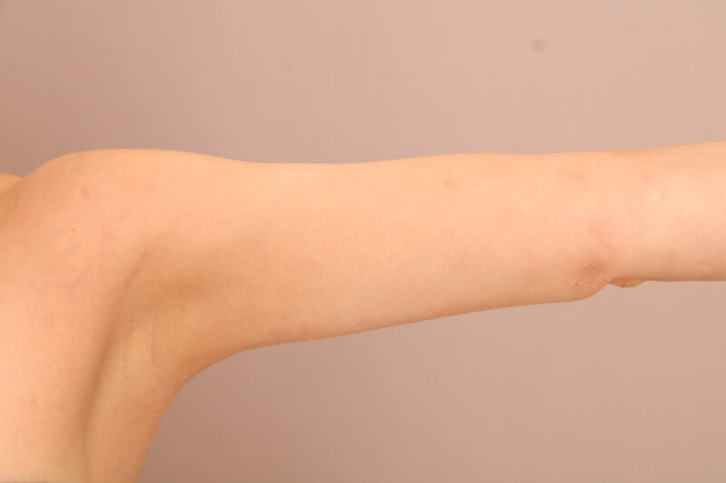 二の腕・肩の脂肪吸引 術後3ヵ月の経過