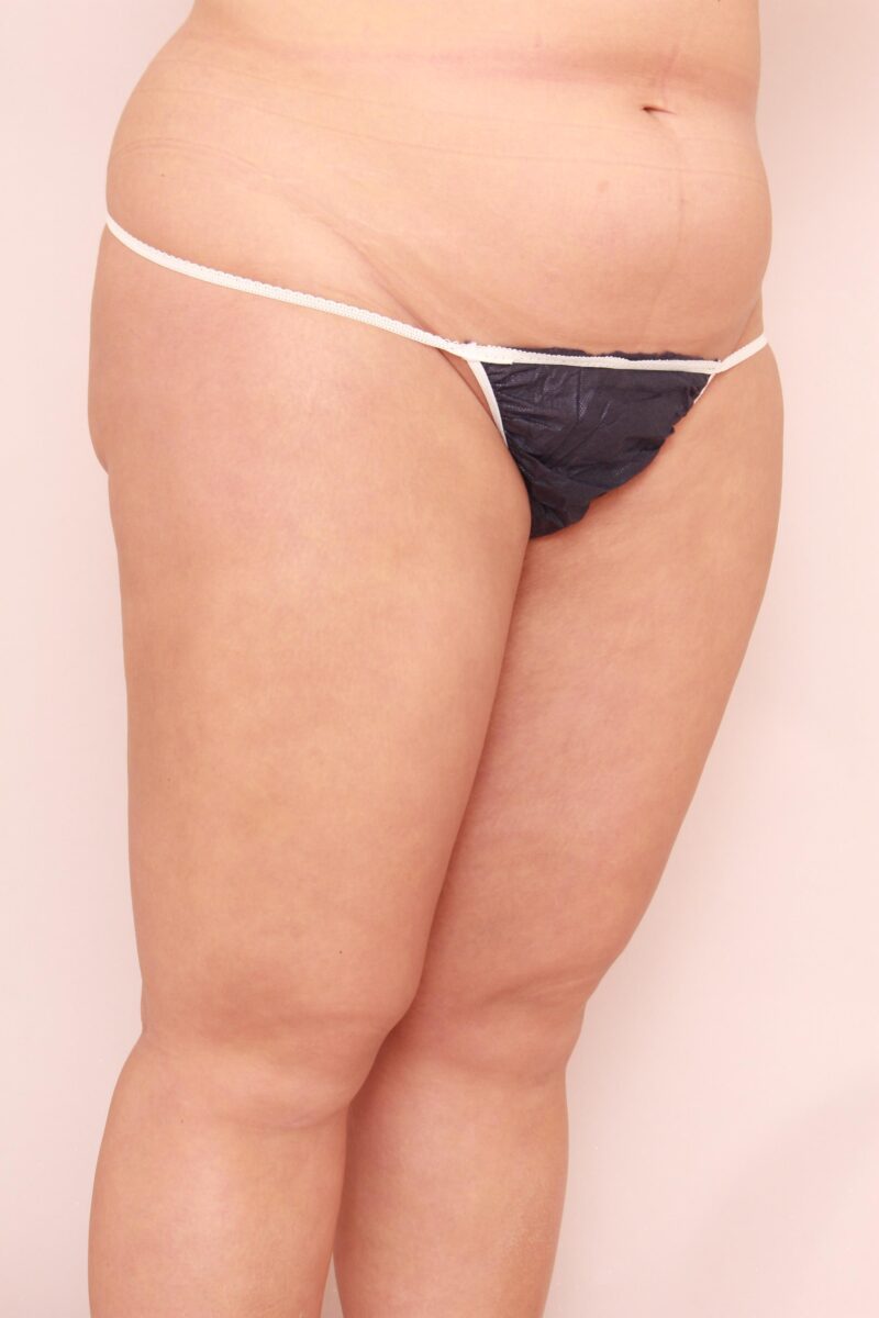 他院で断られた方の太もも全周お尻膝の脂肪吸引1か月後♡