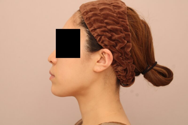 お顔の脂肪吸引 術後6ヵ月の経過