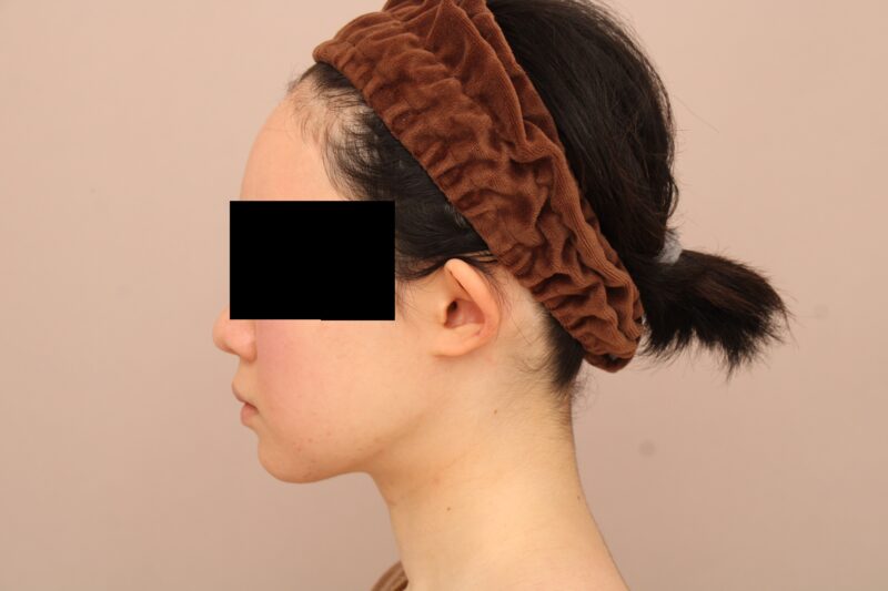 お顔の脂肪吸引 術後6ヵ月の経過